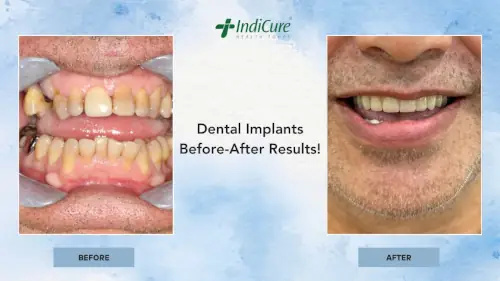 Vincent - Dental Implants Before-After Results